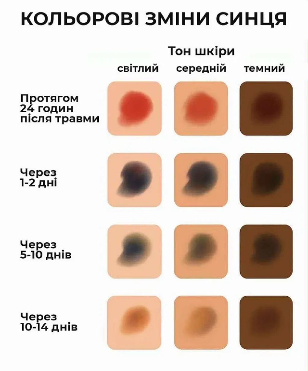Чому з’являються синці та як вони змінюють колір: пояснюють медики